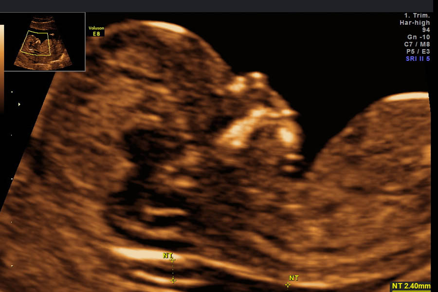 erstrimesterscreening